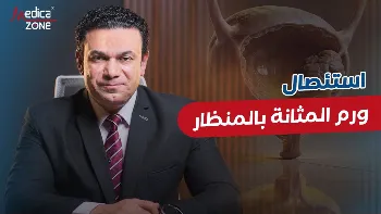 هل يؤثر استئصال ورم المثانة بالمنظار في الإنجاب؟